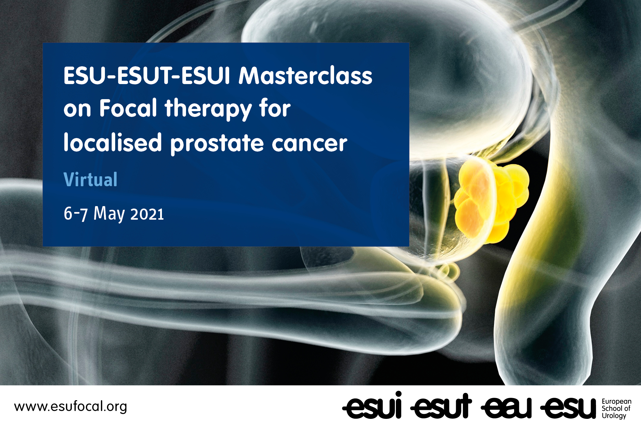 ESU-ESUT-ESUI Virtual Masterclass on Focal therapy for localised prostate cancer