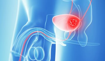 EAU Update on Bladder Cancer 2019 (BCa19)