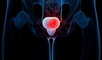 Masterclass on Non-Muscle-Invasive Bladder Cancer