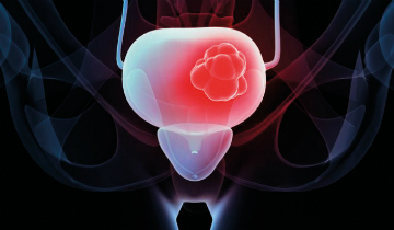 ESU-ESOU Masterclass on Non-Muscle-Invasive Bladder Cancer