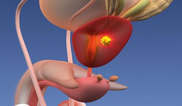 4th EAU Update on Prostate Cancer (PCa20 Virtual Update)